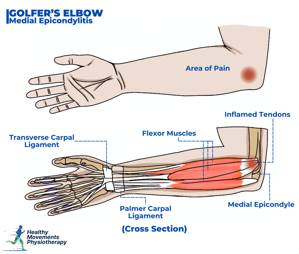 Illustration of Medial Epicondylitis (Golfer’s Elbow) showing inflammation of the flexor tendon attachment on the inner side of the elbow.
