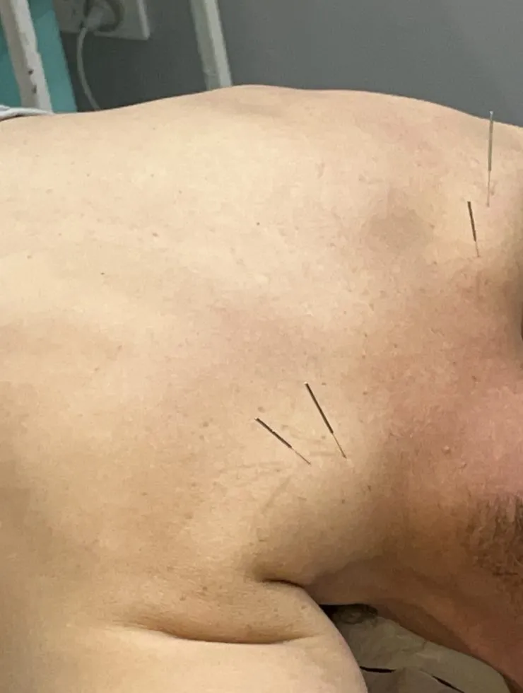 Dry needling is an adaptation of Chinese Acupuncture