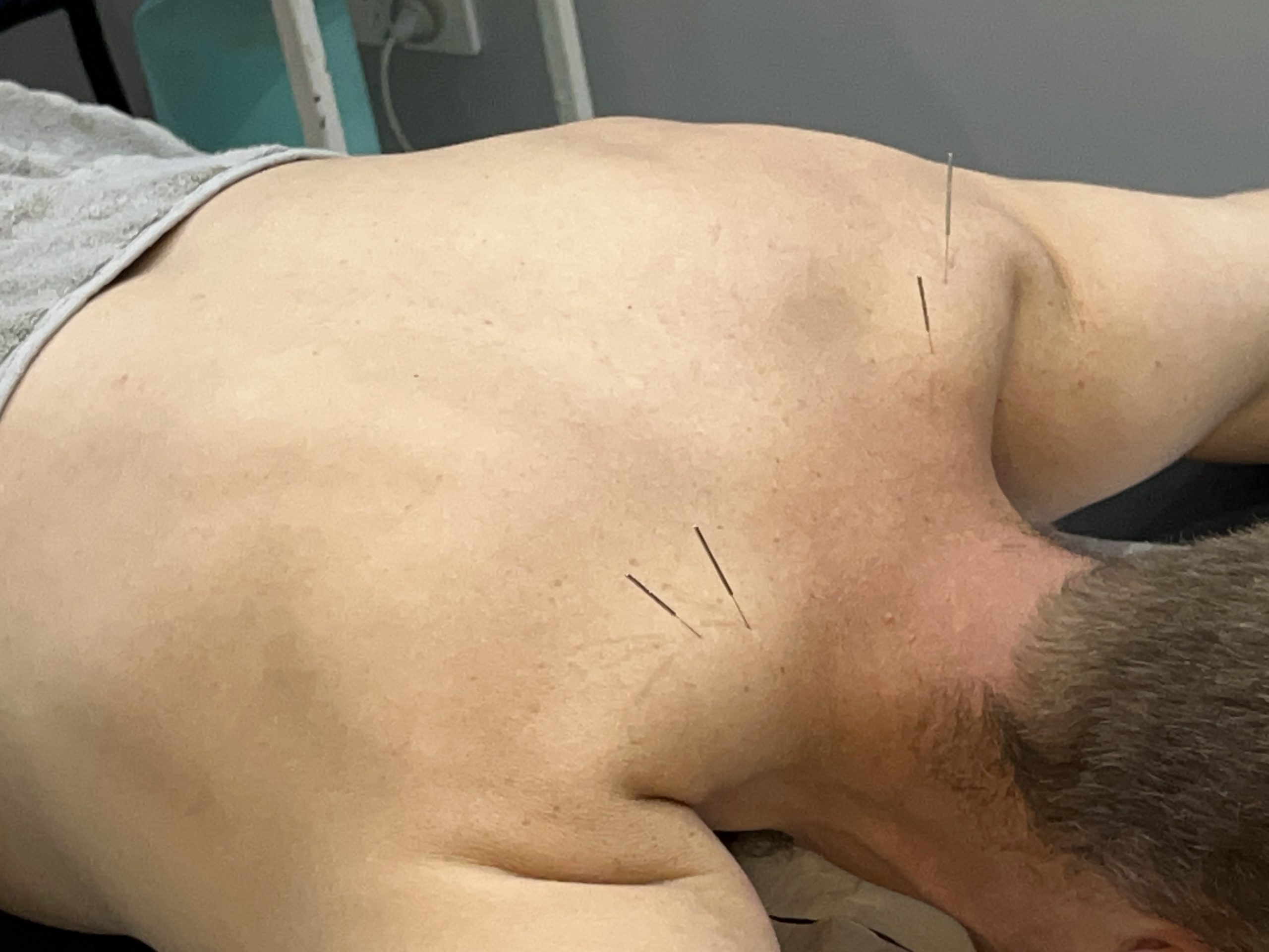 Dry needling is an adaptation of Chinese Acupuncture