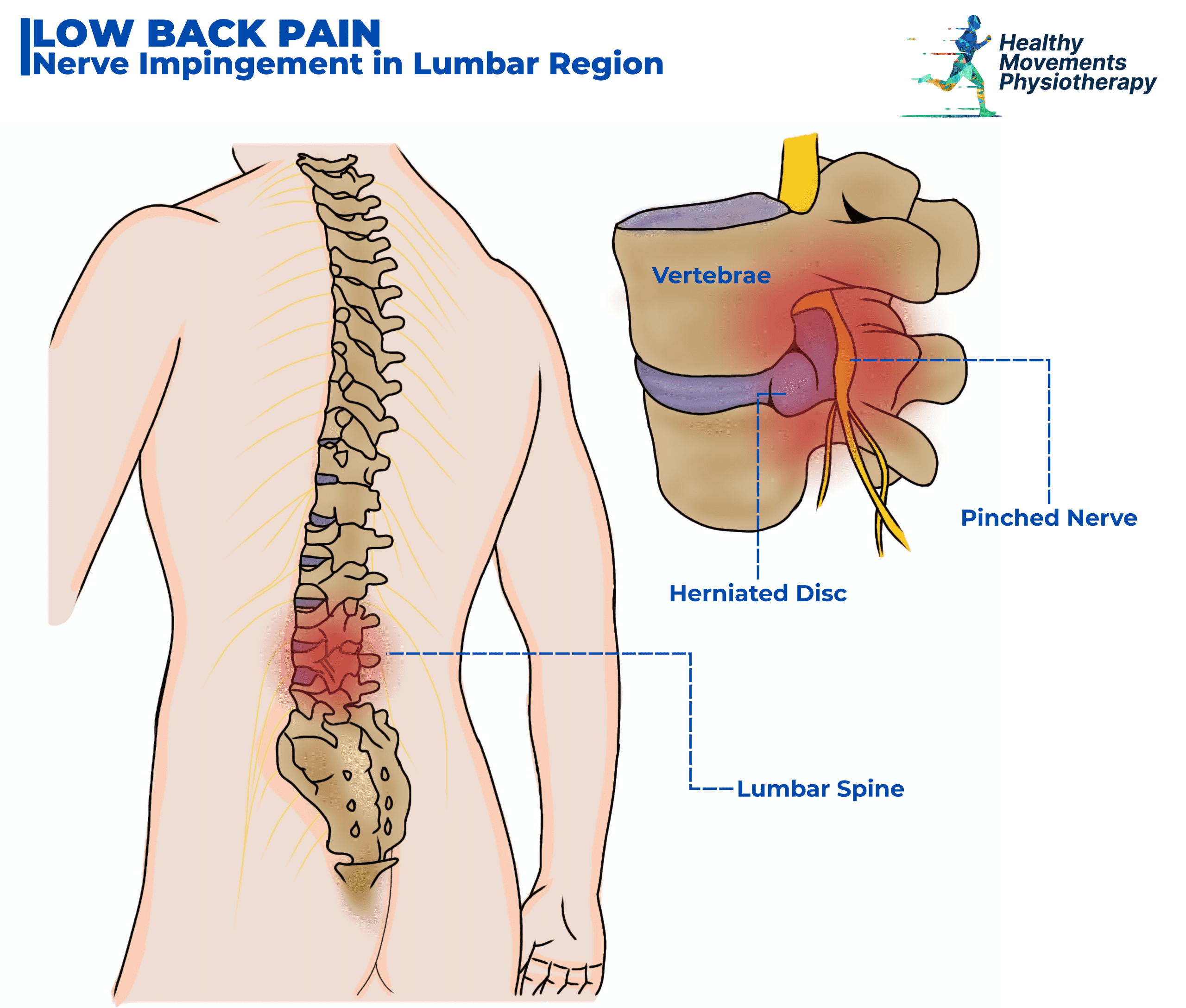 Illustration showing the source of low back pain with highlighted lumbar spine, muscles, and potential disc involvement.