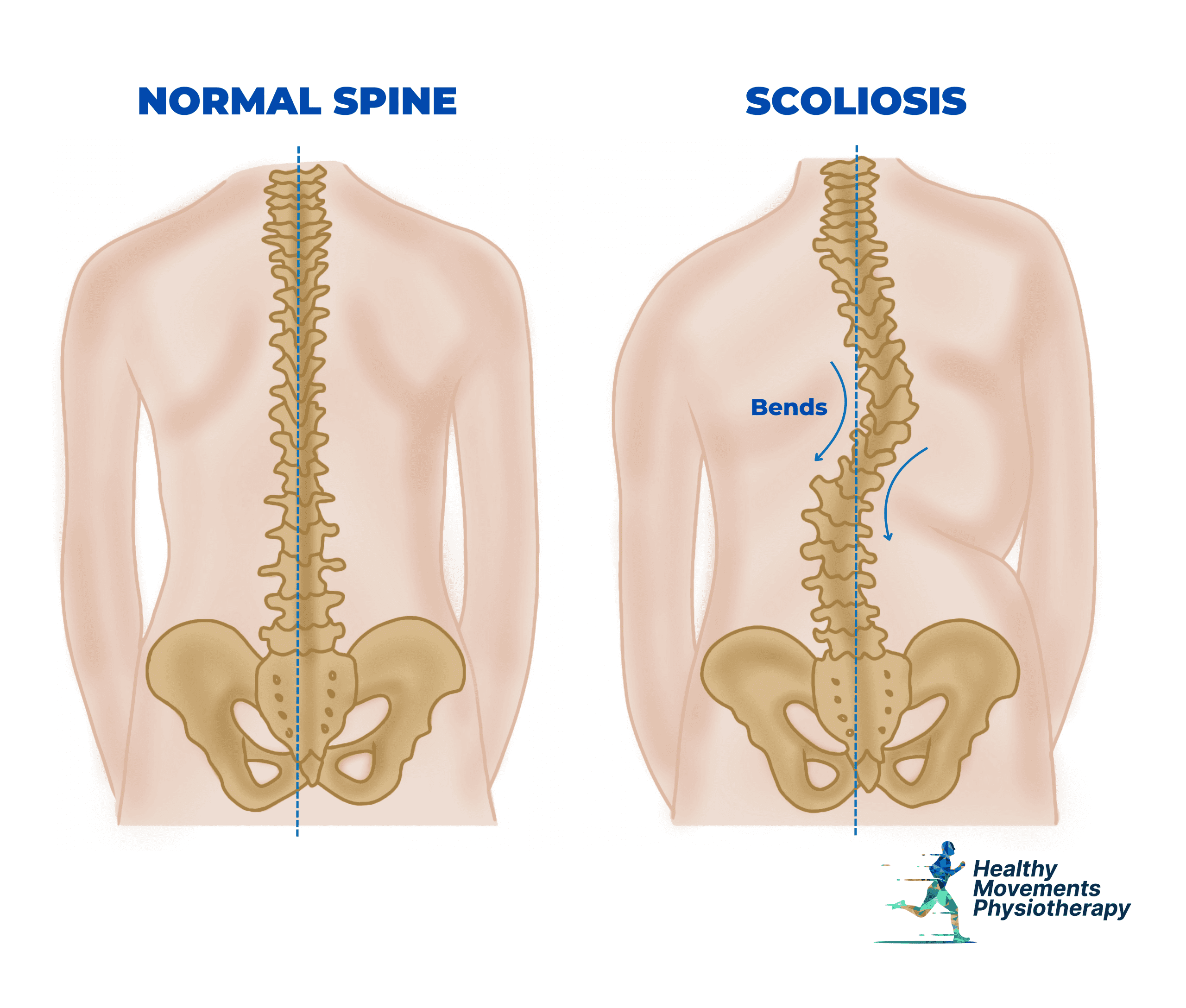 Diagram or X-ray of scoliosis showing an abnormal lateral curvature of the spine in an S or C shape.